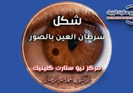 شكل سرطان العين بالصور
