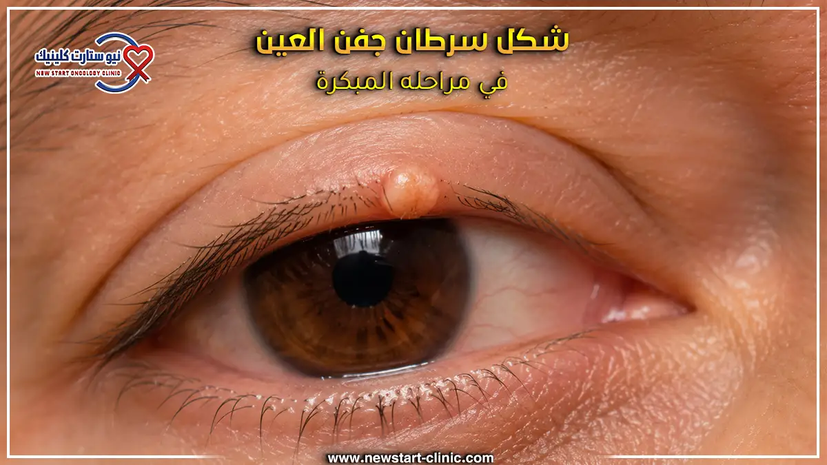 شكل سرطان جفن العين في مراحله المبكرة