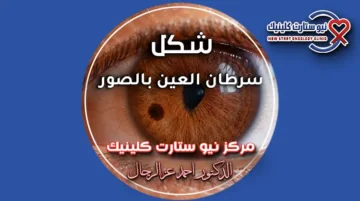 شكل سرطان العين بالصور