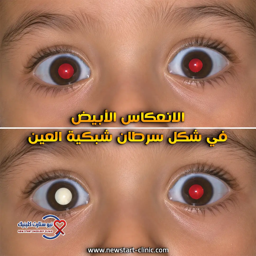 الانعكاس الأبيض في شكل سرطان شبكية العين