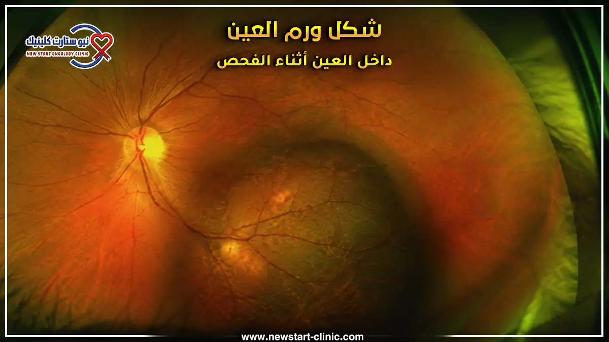 شكل ورم العين داخل العين أثناء الفحص