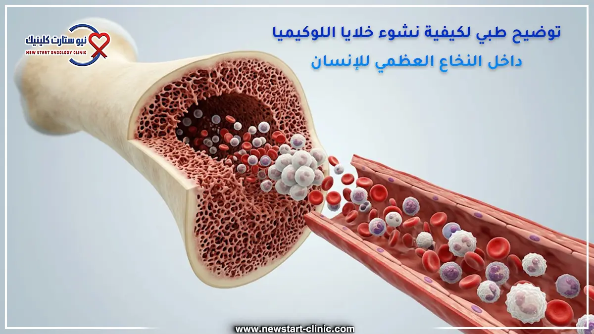 توضيح طبي لكيفية نشوء خلايا اللوكيميا داخل النخاع العظمي للإنسان