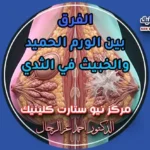 الفرق بين الورم الحميد والخبيث في الثدي العلامات والفحوصات بمركز نيو ستارت كلينيك