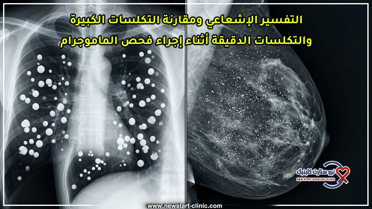 التفسير الإشعاعي ومقارنة التكلسات الكبيرة والتكلسات الدقيقة أثناء إجراء فحص الماموجرام