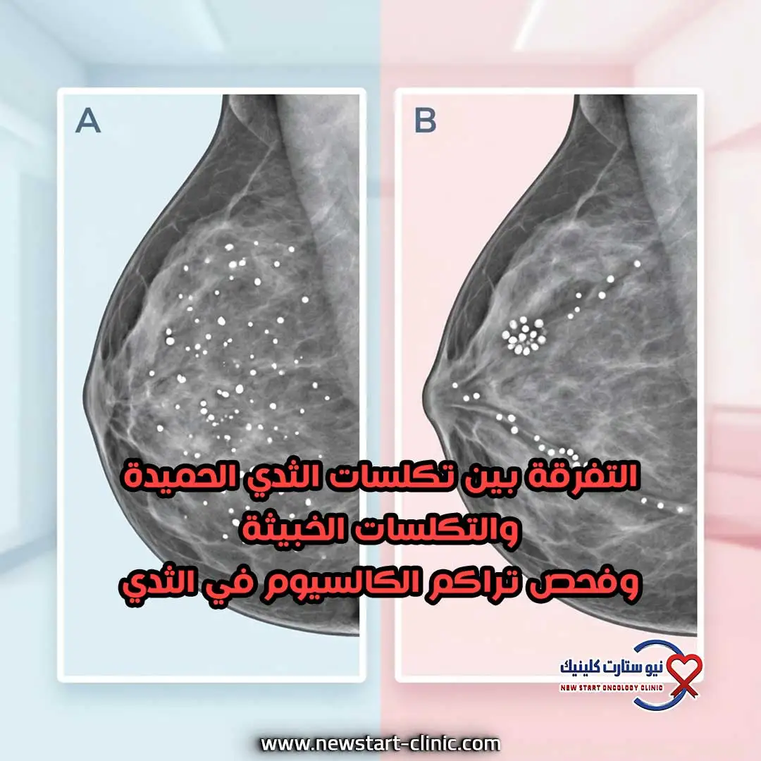 التفرقة بين تكلسات الثدي الحميدة والتكلسات الخبيثة وفحص تراكم الكالسيوم في الثدي