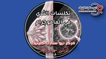 تكلسات الثدي في الماموجرام متى تكون حميدة ومتى تشير لورم بمركز نيو ستارت كلينيك