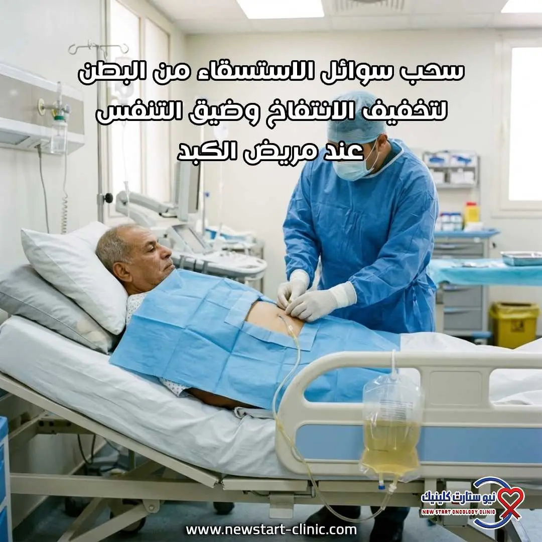سحب سوائل الاستسقاء من البطن لتخفيف الانتفاخ وضيق التنفس عند مريض الكبد